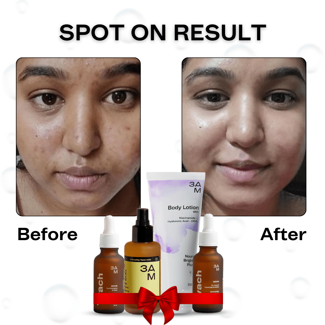 Anti - acne Ultimate Combo - 3AM India